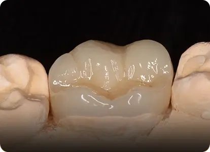 Керамические реставрации